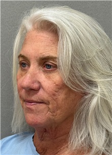 Neck Lift Before Photo by Keshav Magge, MD; Bethesda, MD - Case 50861