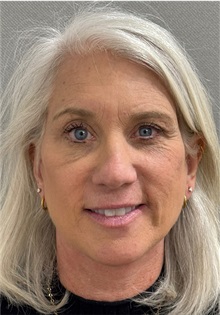 Neck Lift After Photo by Keshav Magge, MD; Bethesda, MD - Case 50861