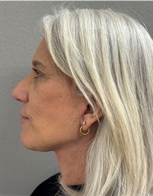 Neck Lift After Photo by Keshav Magge, MD; Bethesda, MD - Case 50861