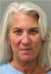 Facelift Before Photo by Keshav Magge, MD; Bethesda, MD - Case 50863