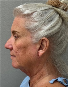 Facelift Before Photo by Keshav Magge, MD; Bethesda, MD - Case 50863