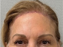 Brow Lift After Photo by Keshav Magge, MD; Bethesda, MD - Case 50864