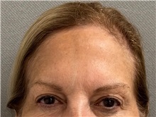 Brow Lift Before Photo by Keshav Magge, MD; Bethesda, MD - Case 50864
