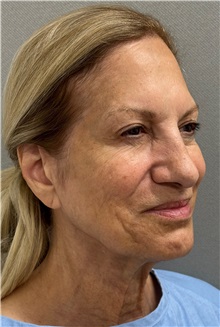 Facelift Before Photo by Keshav Magge, MD; Bethesda, MD - Case 50869