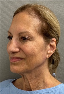 Facelift Before Photo by Keshav Magge, MD; Bethesda, MD - Case 50869