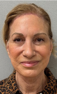 Facelift After Photo by Keshav Magge, MD; Bethesda, MD - Case 50869
