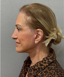 Facelift After Photo by Keshav Magge, MD; Bethesda, MD - Case 50869