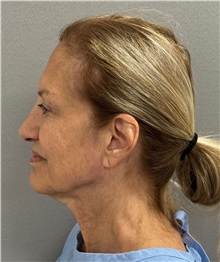 Facelift Before Photo by Keshav Magge, MD; Bethesda, MD - Case 50869