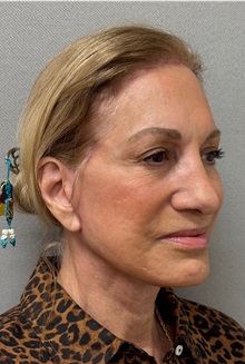 Neck Lift After Photo by Keshav Magge, MD; Bethesda, MD - Case 50868