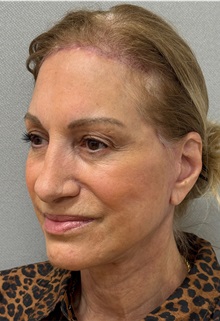 Neck Lift After Photo by Keshav Magge, MD; Bethesda, MD - Case 50868
