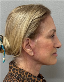 Neck Lift After Photo by Keshav Magge, MD; Bethesda, MD - Case 50868