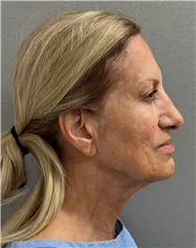 Neck Lift Before Photo by Keshav Magge, MD; Bethesda, MD - Case 50868
