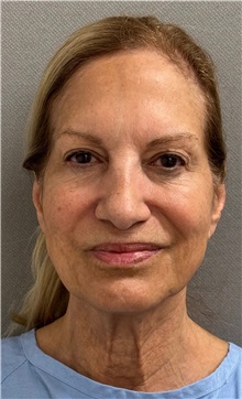 Neck Lift Before Photo by Keshav Magge, MD; Bethesda, MD - Case 50868
