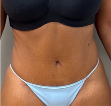 Tummy Tuck After Photo by Keshav Magge, MD; Bethesda, MD - Case 50924