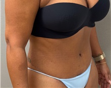 Tummy Tuck After Photo by Keshav Magge, MD; Bethesda, MD - Case 50924