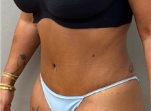 Tummy Tuck After Photo by Keshav Magge, MD; Bethesda, MD - Case 50924