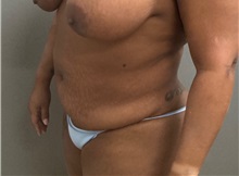 Tummy Tuck Before Photo by Keshav Magge, MD; Bethesda, MD - Case 50924