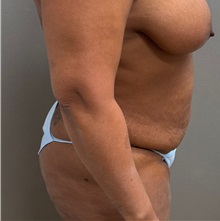 Tummy Tuck Before Photo by Keshav Magge, MD; Bethesda, MD - Case 50924