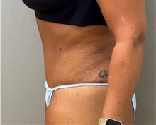 Tummy Tuck After Photo by Keshav Magge, MD; Bethesda, MD - Case 50924