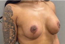 Breast Lift After Photo by Keshav Magge, MD; Bethesda, MD - Case 50925