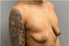 Breast Lift Before Photo by Keshav Magge, MD; Bethesda, MD - Case 50925