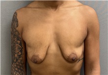 Breast Lift Before Photo by Keshav Magge, MD; Bethesda, MD - Case 50925