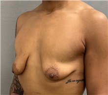 Breast Lift Before Photo by Keshav Magge, MD; Bethesda, MD - Case 50925