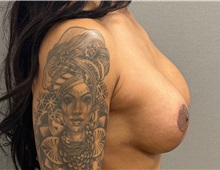 Breast Lift After Photo by Keshav Magge, MD; Bethesda, MD - Case 50925
