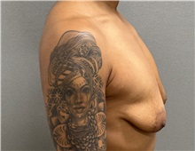 Breast Lift Before Photo by Keshav Magge, MD; Bethesda, MD - Case 50925