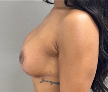 Breast Lift After Photo by Keshav Magge, MD; Bethesda, MD - Case 50925