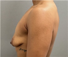 Breast Lift Before Photo by Keshav Magge, MD; Bethesda, MD - Case 50925