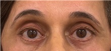 Eyelid Surgery After Photo by Keshav Magge, MD; Bethesda, MD - Case 51201