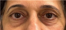 Eyelid Surgery Before Photo by Keshav Magge, MD; Bethesda, MD - Case 51201