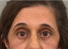Brow Lift After Photo by Keshav Magge, MD; Bethesda, MD - Case 51200