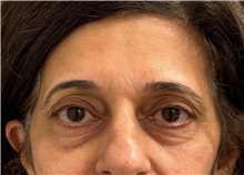 Brow Lift Before Photo by Keshav Magge, MD; Bethesda, MD - Case 51200