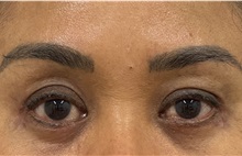 Eyelid Surgery After Photo by Keshav Magge, MD; Bethesda, MD - Case 51246