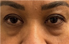 Eyelid Surgery Before Photo by Keshav Magge, MD; Bethesda, MD - Case 51246