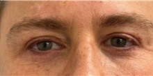 Eyelid Surgery After Photo by Keshav Magge, MD; Bethesda, MD - Case 51245