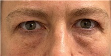 Eyelid Surgery Before Photo by Keshav Magge, MD; Bethesda, MD - Case 51245