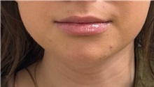 Liposuction After Photo by Keshav Magge, MD; Bethesda, MD - Case 51247