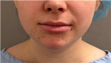 Liposuction Before Photo by Keshav Magge, MD; Bethesda, MD - Case 51247