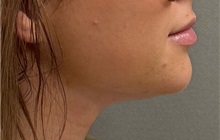 Liposuction After Photo by Keshav Magge, MD; Bethesda, MD - Case 51247