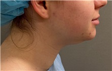 Liposuction Before Photo by Keshav Magge, MD; Bethesda, MD - Case 51247