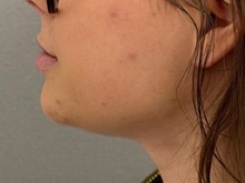Liposuction After Photo by Keshav Magge, MD; Bethesda, MD - Case 51247