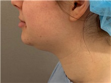 Liposuction Before Photo by Keshav Magge, MD; Bethesda, MD - Case 51247