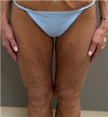 Thigh Lift Before Photo by Keshav Magge, MD; Bethesda, MD - Case 51248