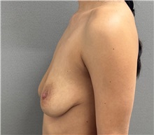 Breast Lift Before Photo by Keshav Magge, MD; Bethesda, MD - Case 51250