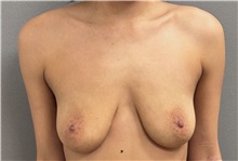 Breast Lift Before Photo by Keshav Magge, MD; Bethesda, MD - Case 51250