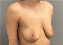 Breast Lift Before Photo by Keshav Magge, MD; Bethesda, MD - Case 51250