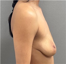 Breast Lift Before Photo by Keshav Magge, MD; Bethesda, MD - Case 51250